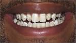 http://cosmeticdentist.com/hypocalcification.jpg