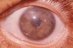 Corneal Dystrophy, Macular | Hereditary Ocular Diseases