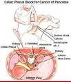 + <b>Celiac Plexus</b> Block +