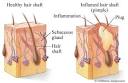  What is the best anti acne skincare product?