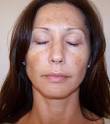 hyperpigmentation | Serenity Skin Care of Grosse Pointe