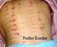 Testing For Allergies - No Need for the Pricks?
