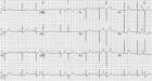by <b>premature atrial</b> beats.