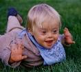 Tri-State Down <b>Syndrome</b>
