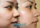  Microdermabrasion for Acne Scars Treatment: Does It Really Work?