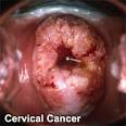 Know the Cervical Cancer 