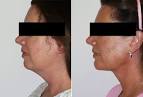 Chin Implant | Maryland Cosmetic Plastic Surgery | Sheilah A ...