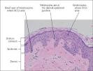 Diagnosis and Treatment of Basal Cell and Squamous Cell Carcinomas ...