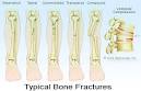 Fracture Causes, Symptoms, Diagnosis, and Treatment by MedicineNet.