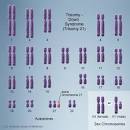 Trisomy