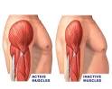neurogenic <b>atrophy</b> is one