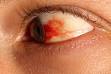 Subconjunctival <b>hemorrhage</b>