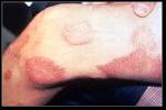 File:Leprosy thigh demarcated - via Daymix