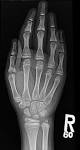 <b>Langer Giedion syndrome</b> - “The