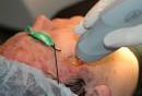  Effectiveness of laser treatment for acne