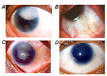 <b>Aniridia</b> - Wikipedia, the free