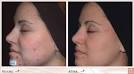  Hormonal Acne   Its Causes and Treatments