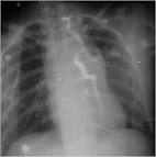 Traumatic thoracic aortic rupture | Unbounded Medicine