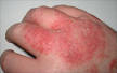 <b>Eczema</b>