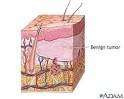 Benign tumor of the skin: MedlinePlus Medical Encyclopedia Image