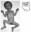 Biology 442, Human Genetics - Chromosome Abnormalities