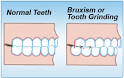 Bruxism - Overview | Medindia