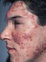  Sandalwood   An Acne Solution?