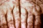 File:Secondary <b>Syphilis</b> on