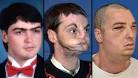 after the face transplant.