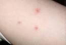 Bug Bites Pictures Slideshow: Identifying Bugs and Bug Bites - WebMD