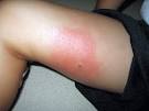 How To Get Rid Of Insect Bites?