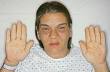 Definition of «<b>Acromegaly</b>»