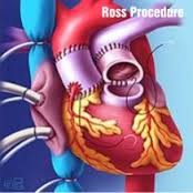 ross procedure