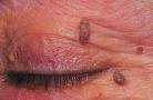 <b>Papilloma</b> definition | Health Dictionary
