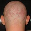 Seborrhoeic dermatitis - Wikipedia, the free encyclopedia