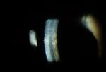 edema in <b>Fuchs dystrophy</b>