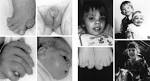 <b>Smith</b>-<b>Lemli</b>-<b>Opitz Syndrome</b>