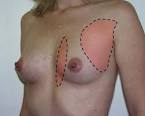 Breast Pain