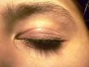 Atopic dermatitis involving the eyelids