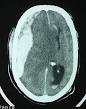 <b>ACUTE SUBDURAL HEMATOMA</b> see