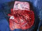 Brain Surgery Offers Kids With Epilepsy a New Lease on Life ...