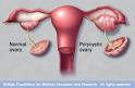 Polycystic <b>ovary</b> syndrome