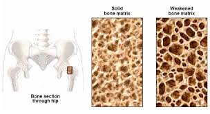 osteopenia