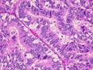 <b>Papillary Carcinoma</b> is one of