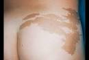 NEUROFIBROMATOSIS (Café au lait) Picture Image on MedicineNet.