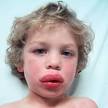 allergic reactions