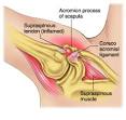 Impingement Syndrome - Medical Disability Guidelines