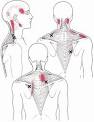 Neck And Shoulder Pain | Neck Shoulder Pain