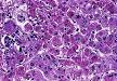 Acute liver failure - Wikipedia, the free encyclopedia