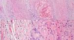 Giant Cell Arteritis - EyeWiki